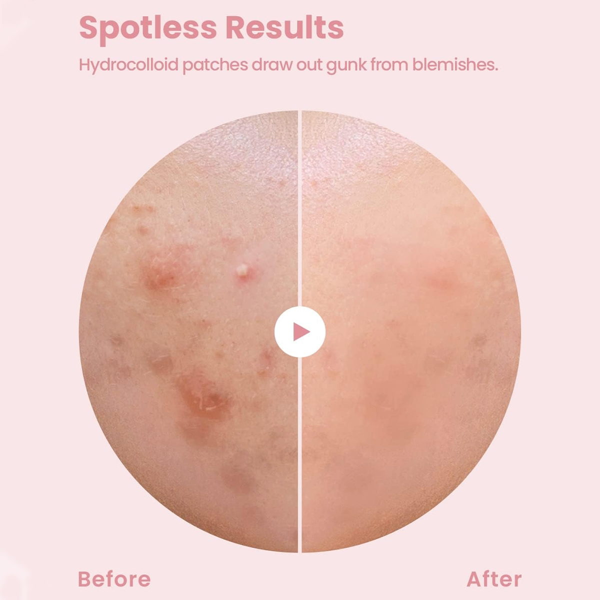 Acne Patches
